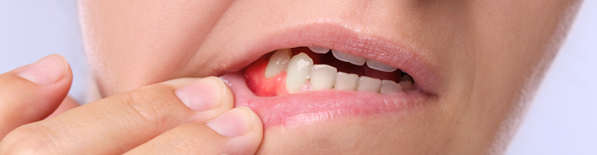 Woman pulling down lower lip to reveal inflamed gums.